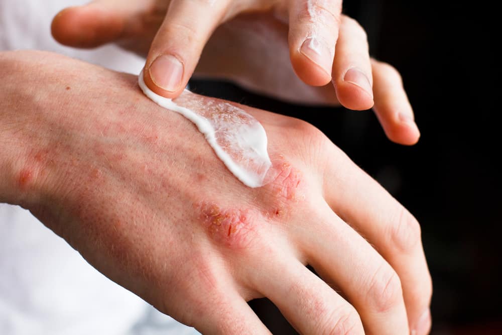 피부의 알레르기 반응을 완화하는 데 도움이 되는 천연 의약품 및 방법