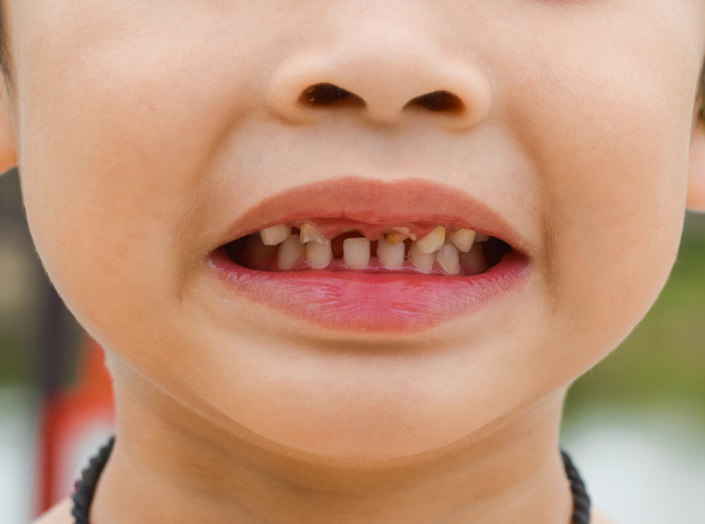 5 causas de los dientes rotos en los niños y consejos de tratamiento
