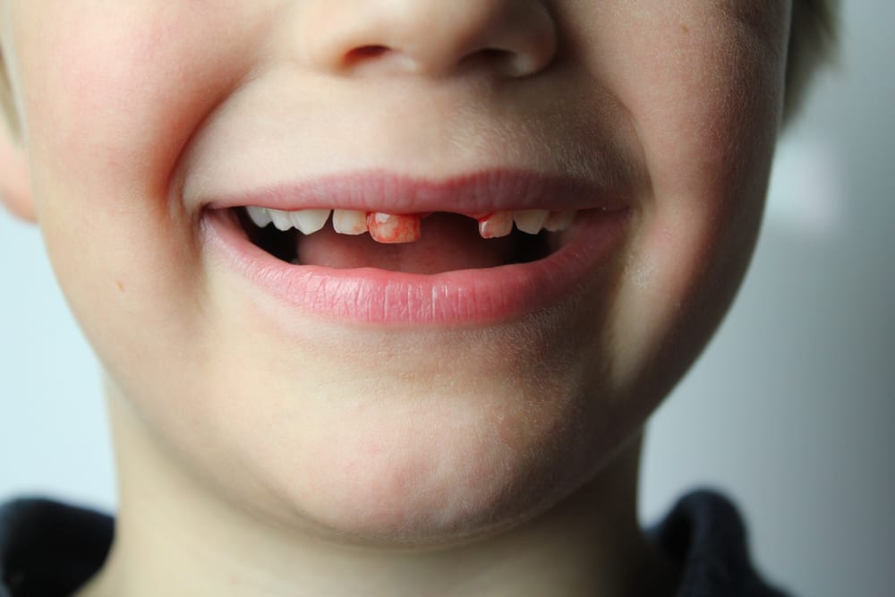 4 consejos poderosos para detener el sangrado de las encías después de la extracción de un diente