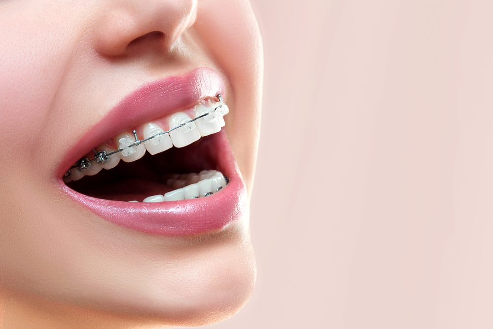 Bevor Sie sich entscheiden, überprüfen Sie zuerst die 4 Unterschiede zwischen Zahnspangen und Invisalign, um Ihre Zähne zu begradigen