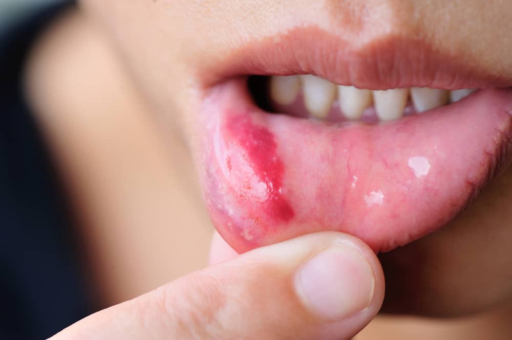 4 tipos de llagas en la boca y sus causas que debe tener en cuenta