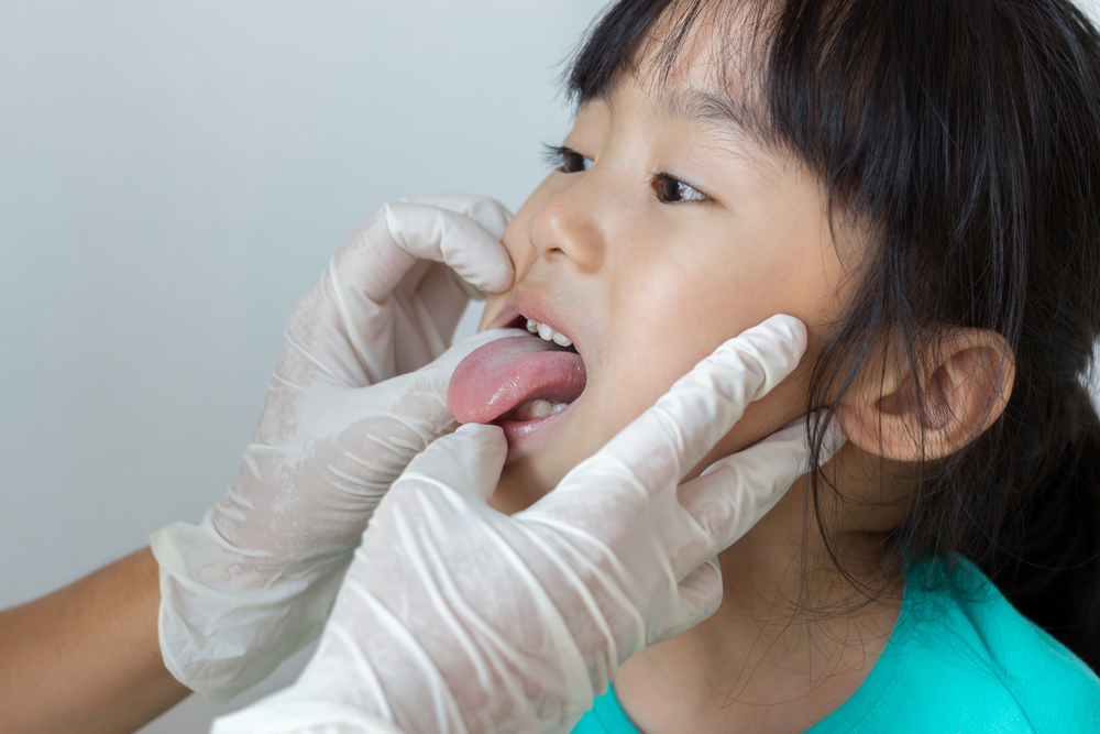 5 causas de sangre en la lengua desde la candidiasis hasta el cáncer