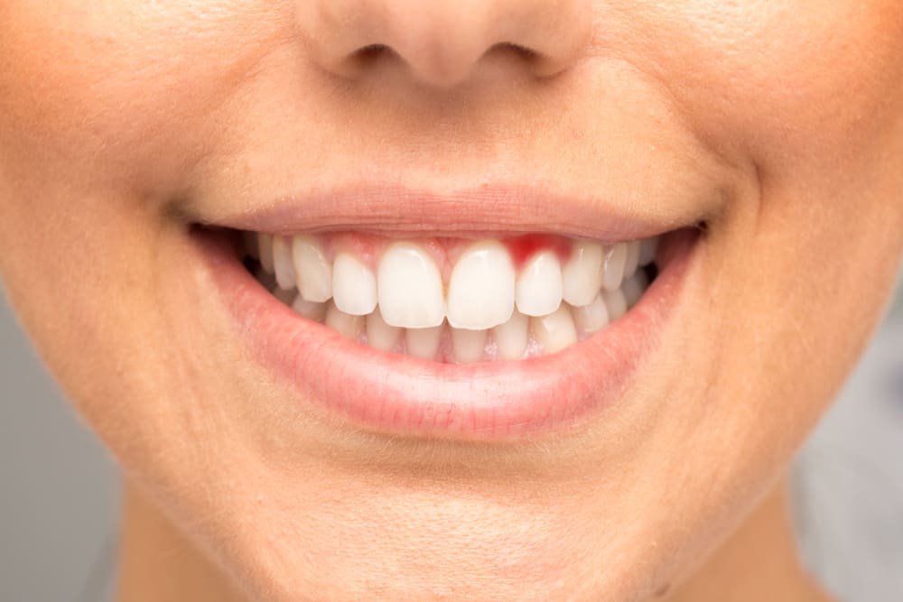 3 tipos de vitaminas eficaces para superar las infecciones de las encías y los dientes