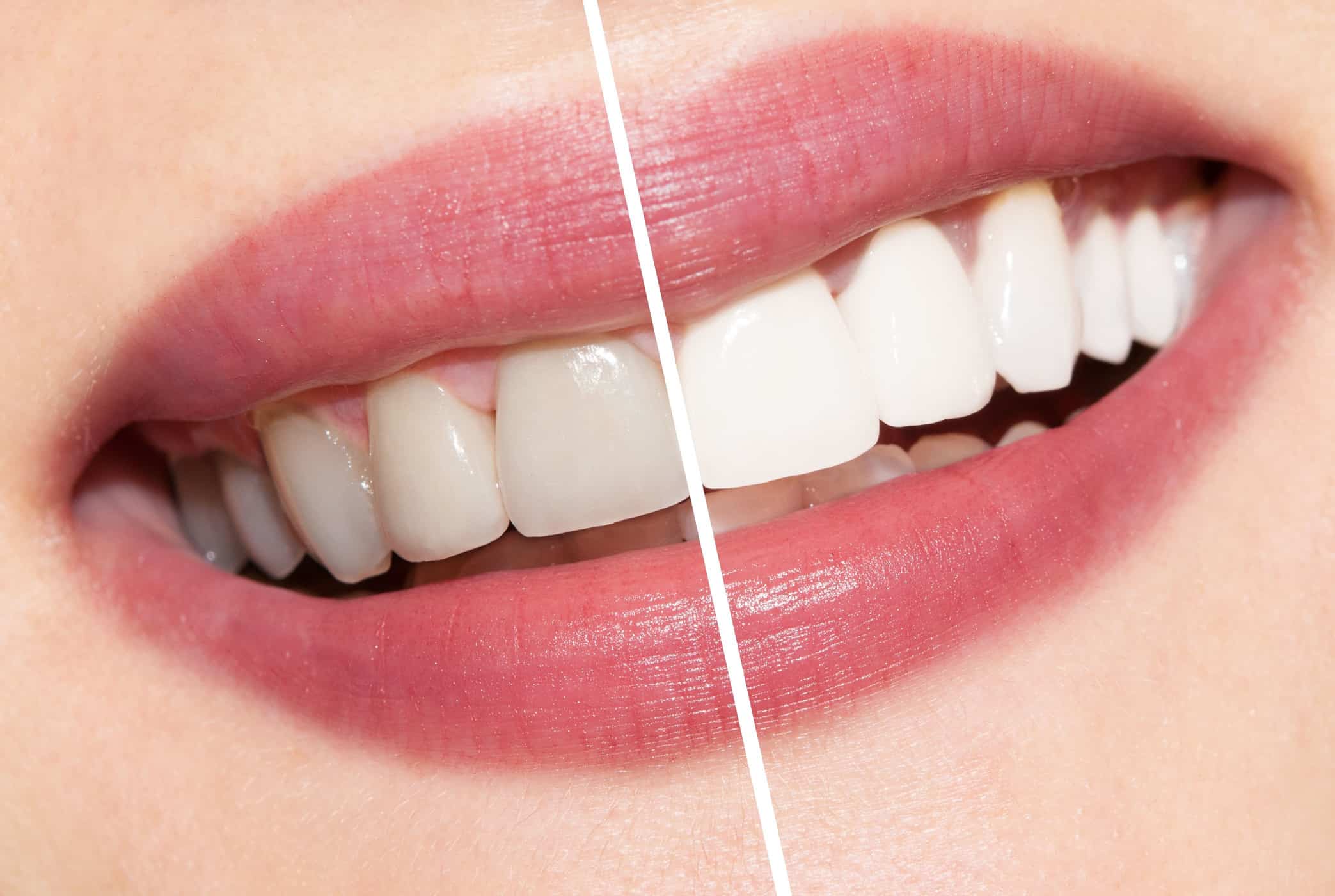Varias formas de blanquear los dientes a través del tratamiento médico
