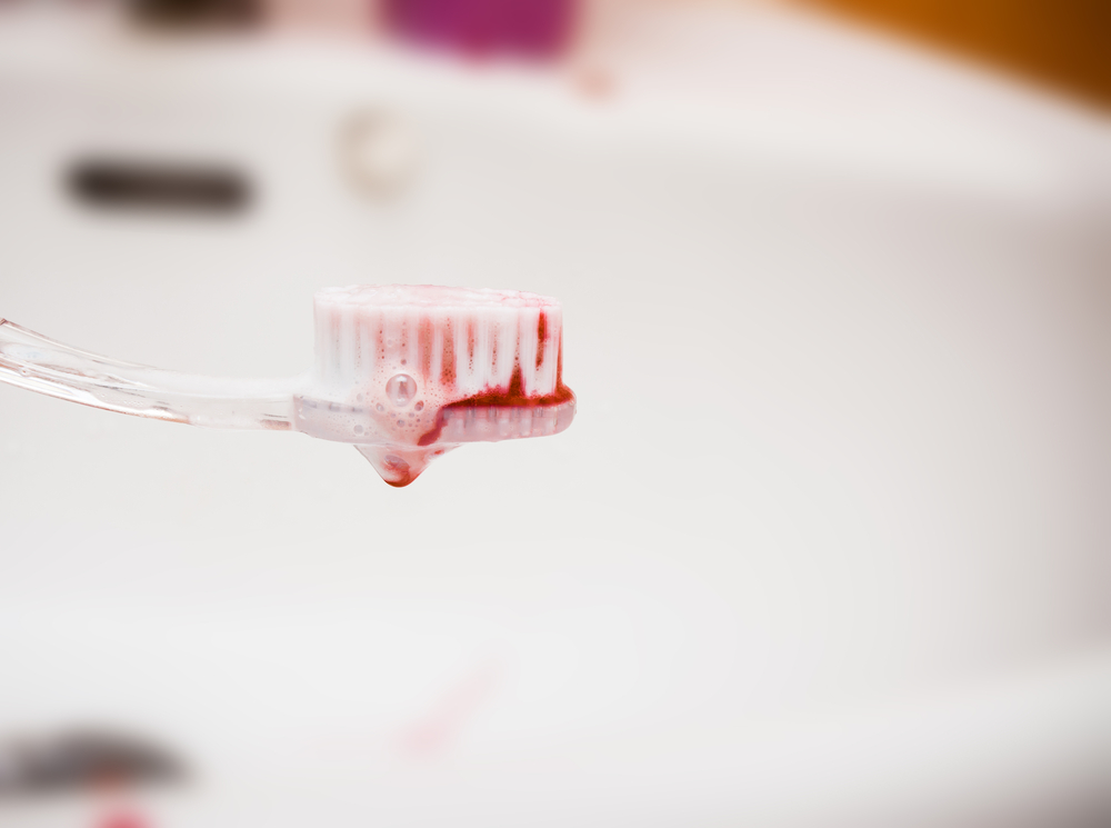 Causas de sangrado de encías al cepillarse los dientes