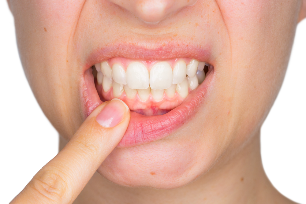 5 Dinge, die blasses Zahnfleisch verursachen, sollten Sie sich Sorgen machen?