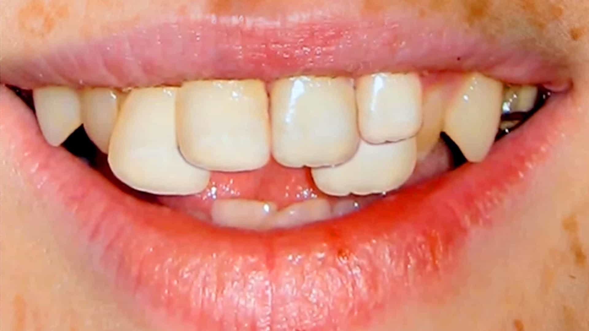 6 condiciones que causan el cambio de dientes y cómo superarlas