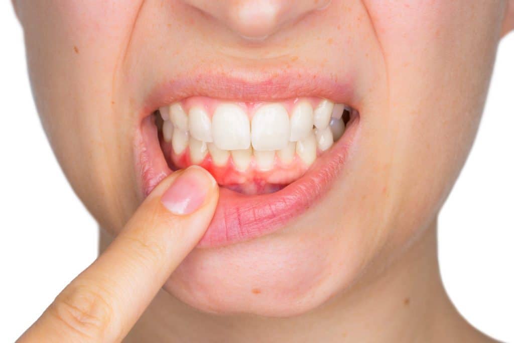 6 Ursachen für juckendes Zahnfleisch, von leichten bis zu gefährlichen Ursachen