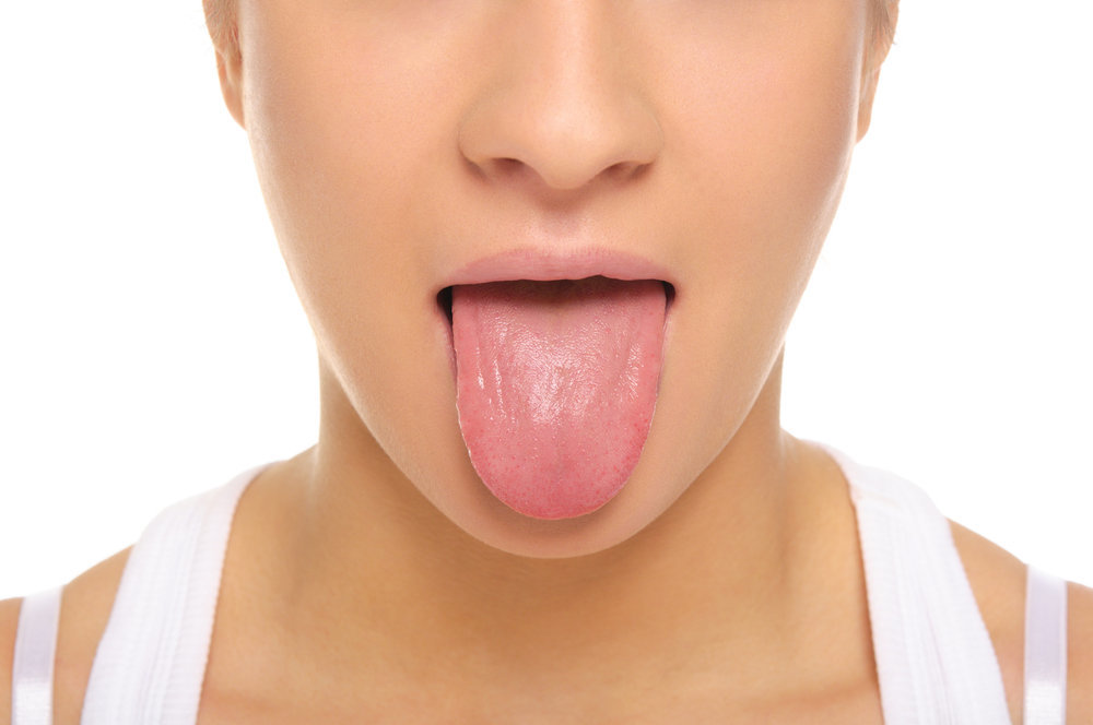 Elección de candidiasis oral natural o infecciones fúngicas en la boca