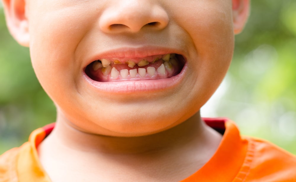 3 causas comunes por las que los dientes de los niños son vulnerables a la caries