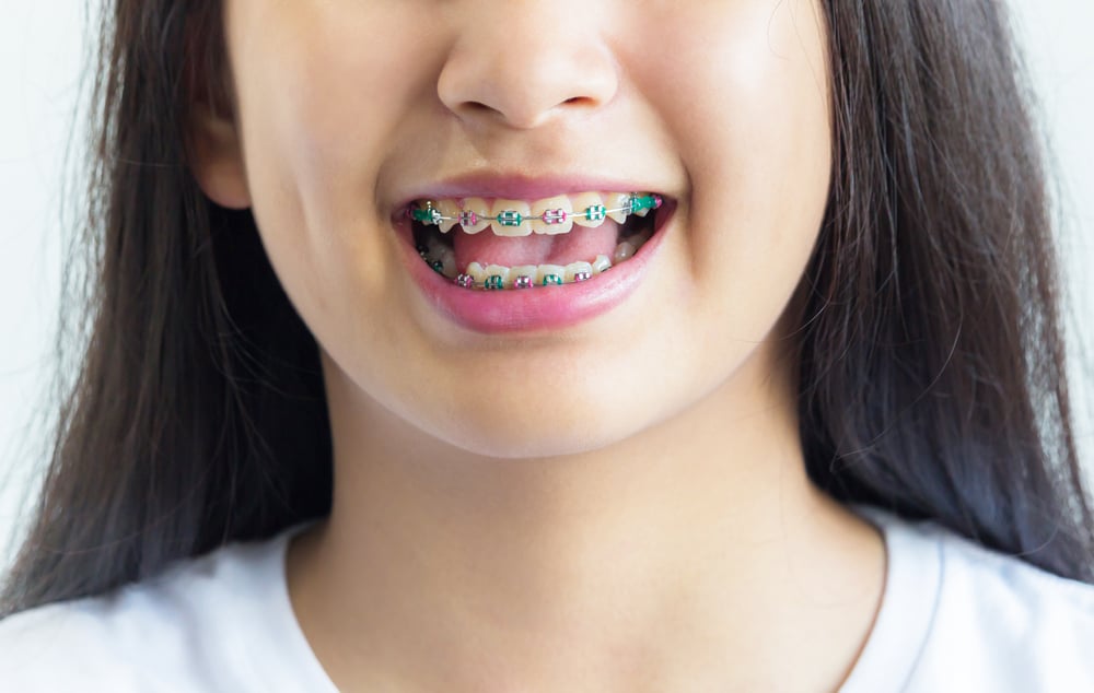 Zahnspangen können Zähne gelb machen, richtig oder falsch?