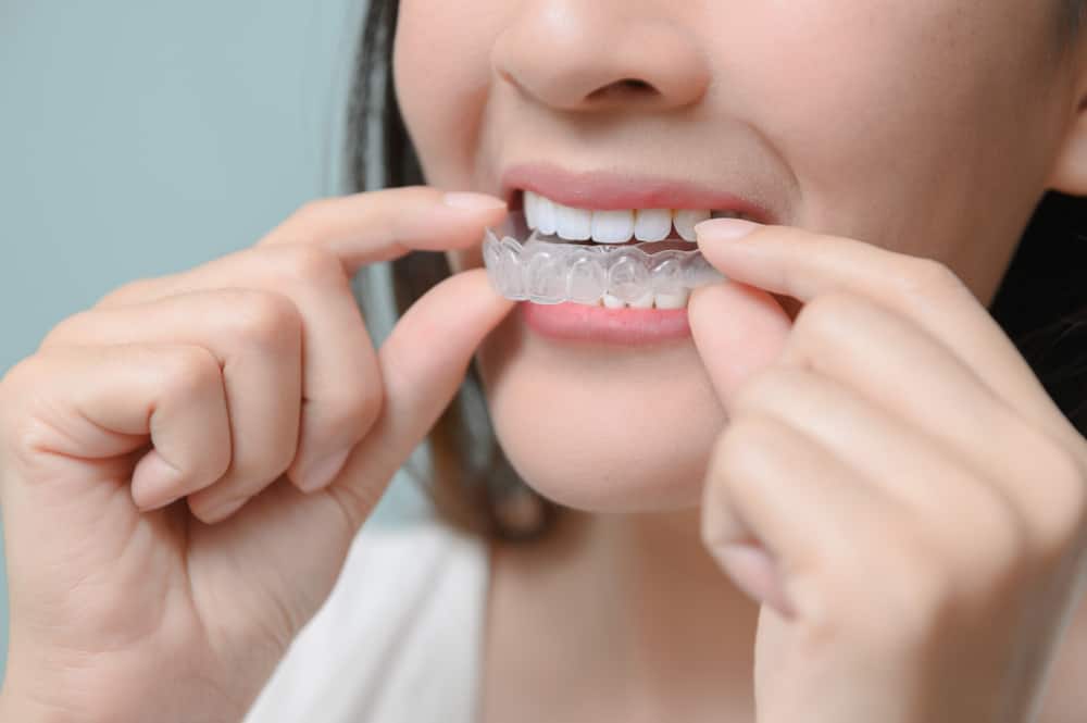 3 Tipps zur Verwendung von transparenten Zahnspangen für optimale Ergebnisse