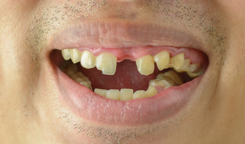 Conozca la hipodoncia, un trastorno genético en el que algunos dientes no crecen