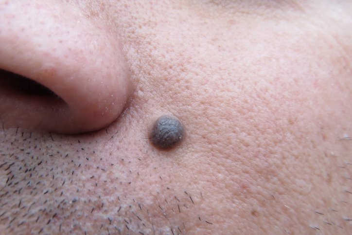 Wie unterscheidet man die Merkmale von Hautkrebs-Maulwürfen von normalen?