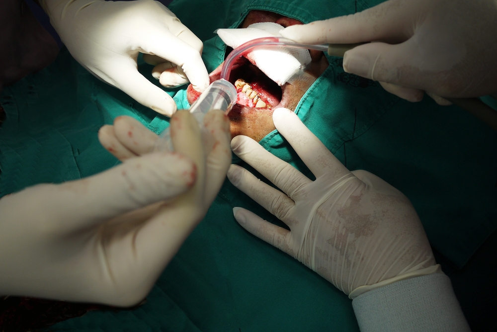 Erkennen Sie die Symptome, Ursachen und Behandlung von Zahnfleischkrebs