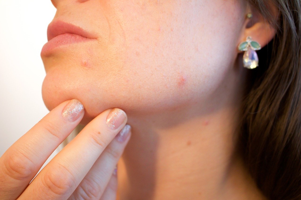 Razones por las que el acné aparece incluso después del tratamiento
