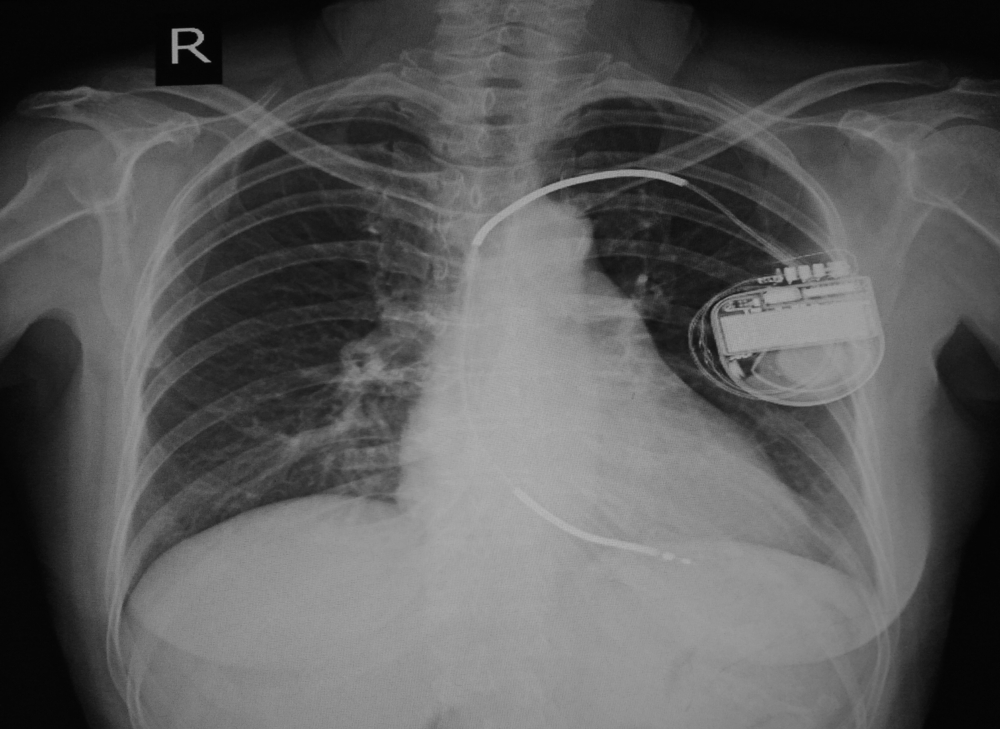 Koliko dugo osoba može preživjeti s pacemakerom?
