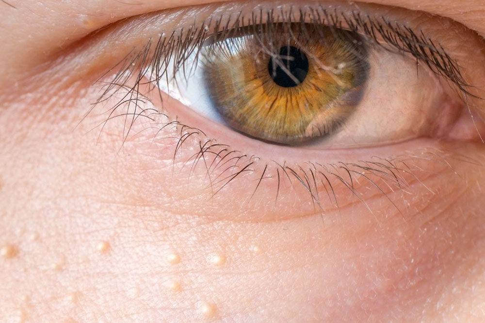 Распознайте сирингому, маленькие шишки, которые часто появляются вокруг глаз