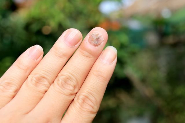 Verschiedene Ursachen von Pilzen auf den Nägeln, die Sie kennen müssen