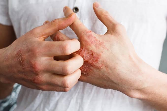 Различные виды дерматита по причинам и симптомам