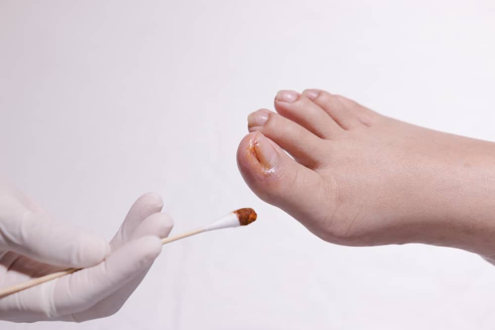 Los 3 tipos más comunes de problemas en las uñas de los pies (más cómo superarlos)