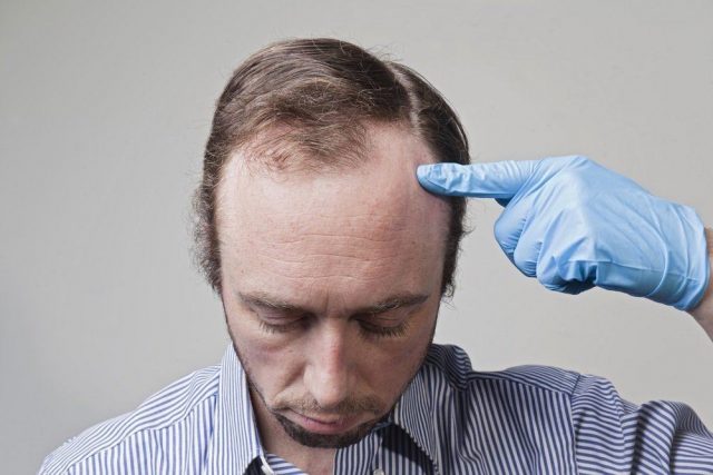 대머리의 징후와 예방 방법