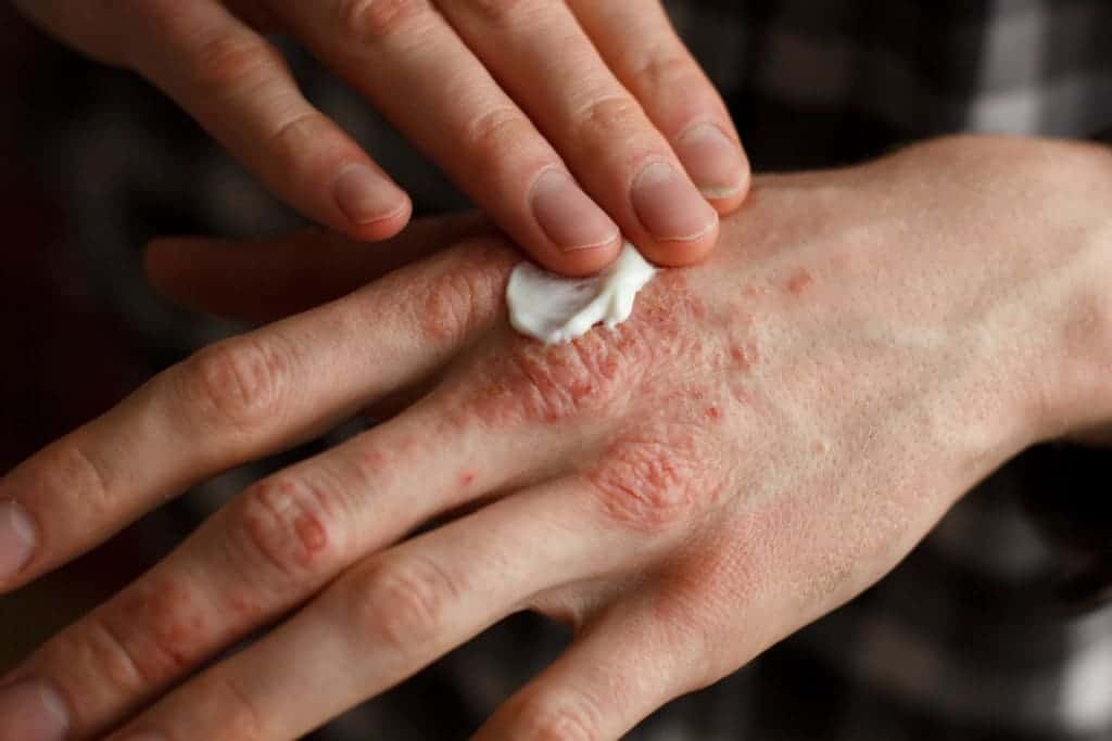 접촉 피부염으로 인한 가려운 피부를 완화하는 다양한 치료법