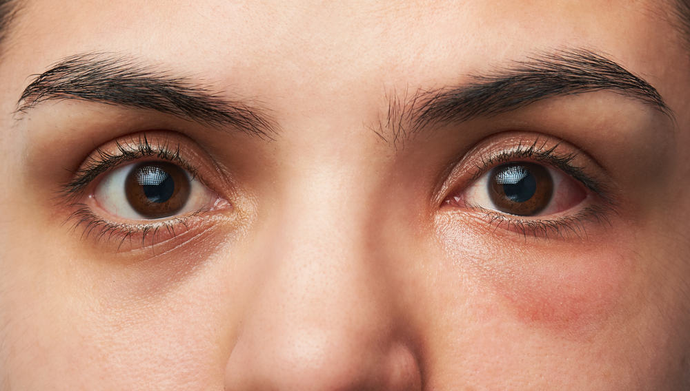 5 causas de infecciones oculares que ocurren con frecuencia (¡Shhh, podrían ser enfermedades sexuales, ya sabes!)