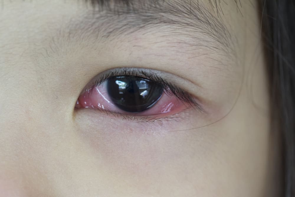 Причины появления красных глаз после слез