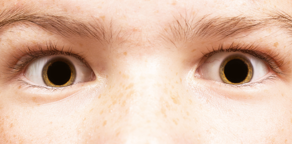Mydriasis, ein Zustand, bei dem die Pupillenerweiterung des Auges anormal ist