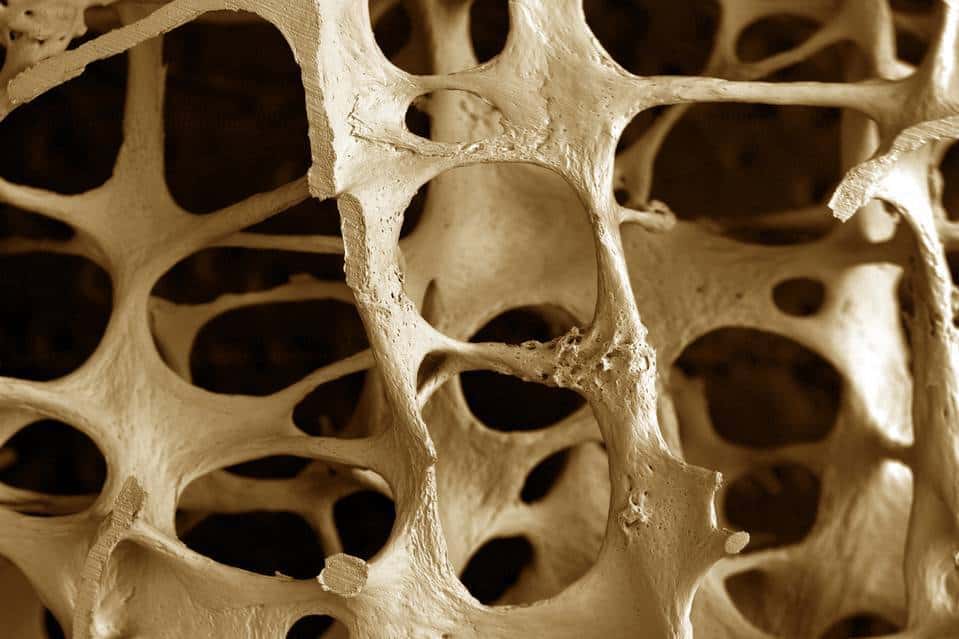 Ursachen und Risikofaktoren der Osteoporose erkennen