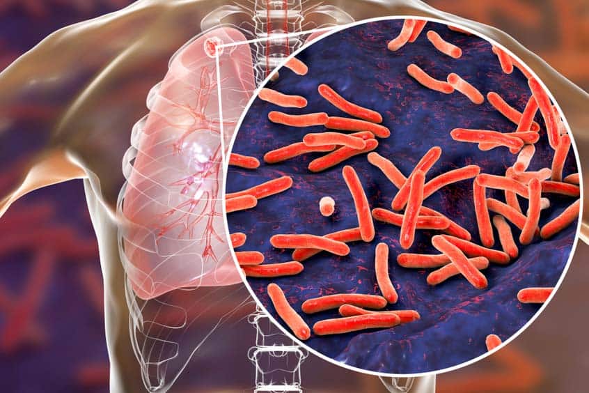 Vorsicht vor latenter TB, ist eine Behandlung erforderlich?