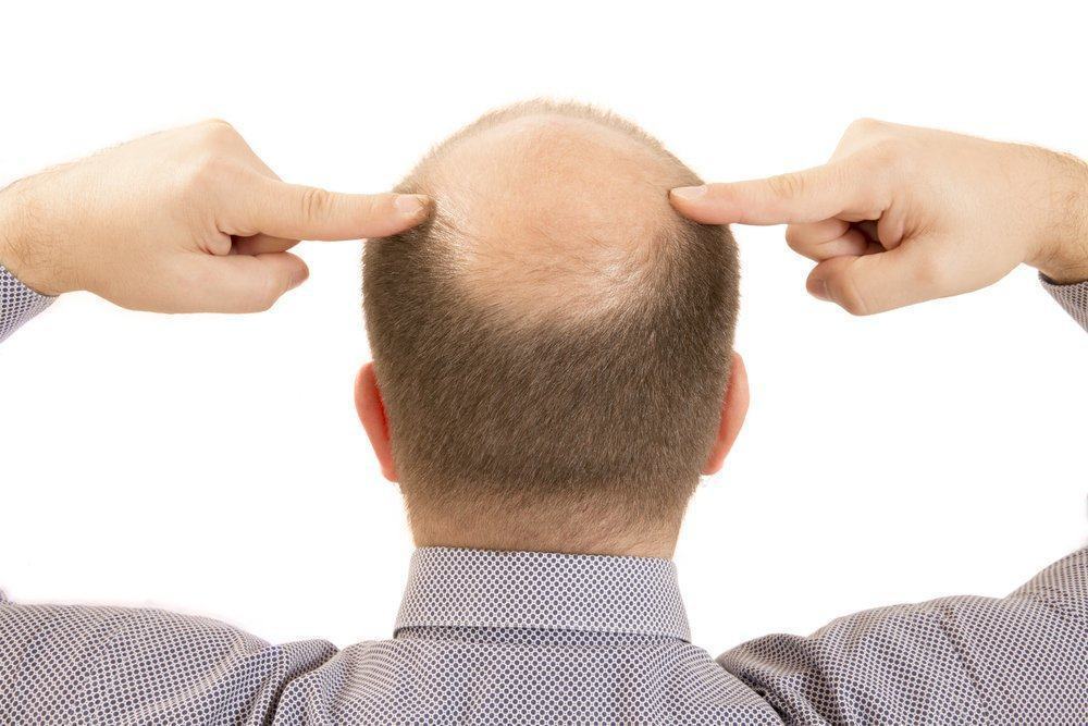 Achtung! Lernen Sie 7 Ursachen für männlichen Haarausfall in jungen Jahren kennen
