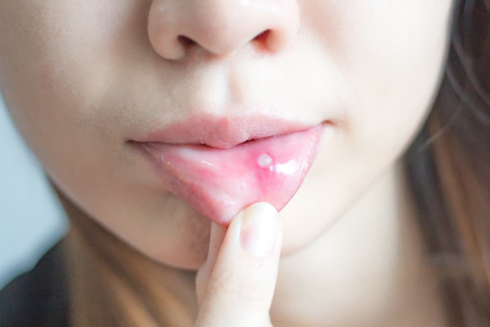Die HPV-Infektion zielt nicht nur auf die Genitalien, sondern auch auf den Mund