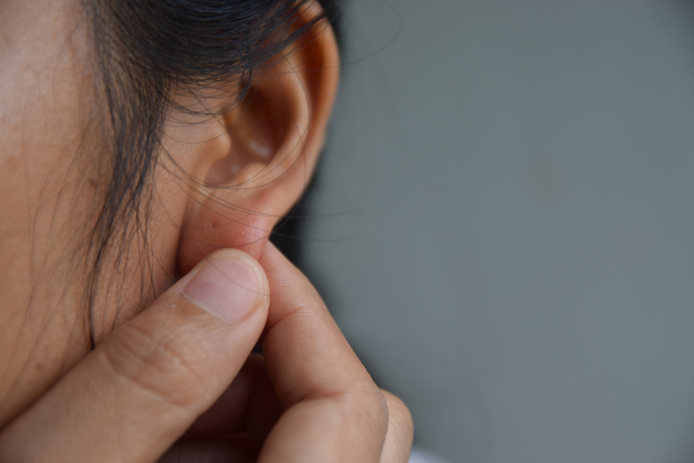 5 medidas médicas efectivas para deshacerse de los queloides rebeldes en el oído