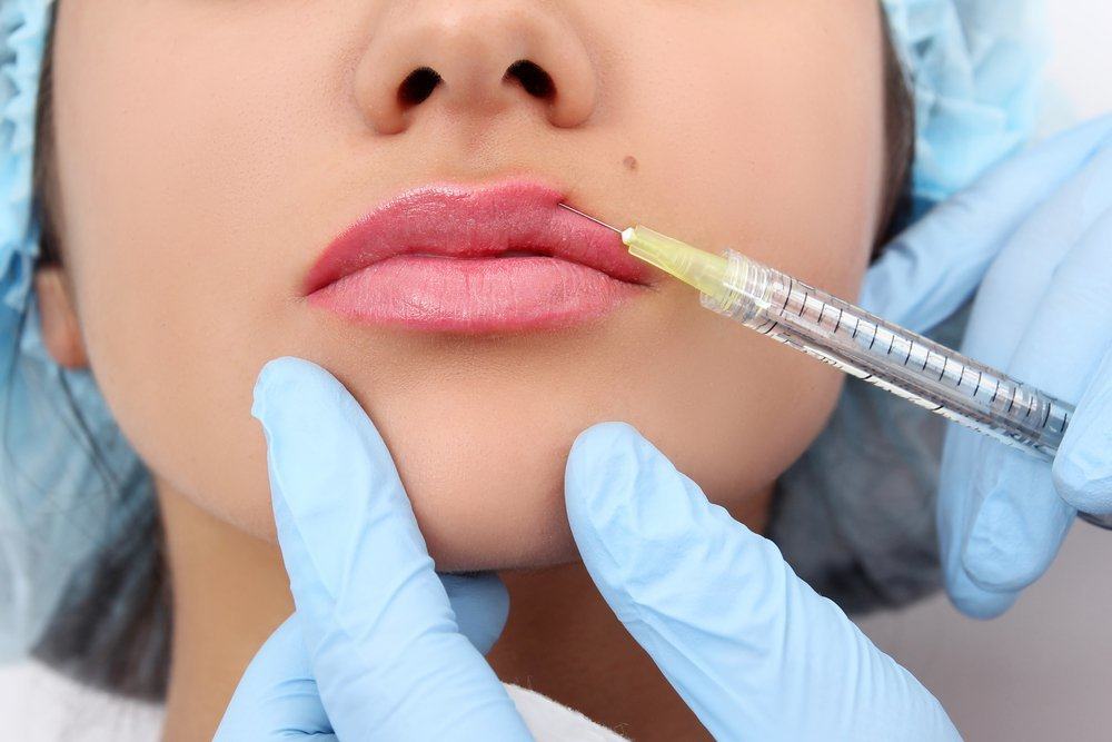 Beneficios y riesgos de engrosar los labios con el relleno de labios