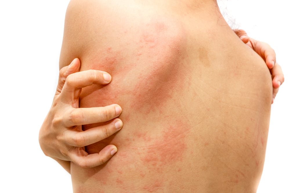 Prekomjeran svrbež kože koji se ljušti nakon uzimanja lijekova? Čuvajte se simptoma Stevens-Johnsonovog sindroma