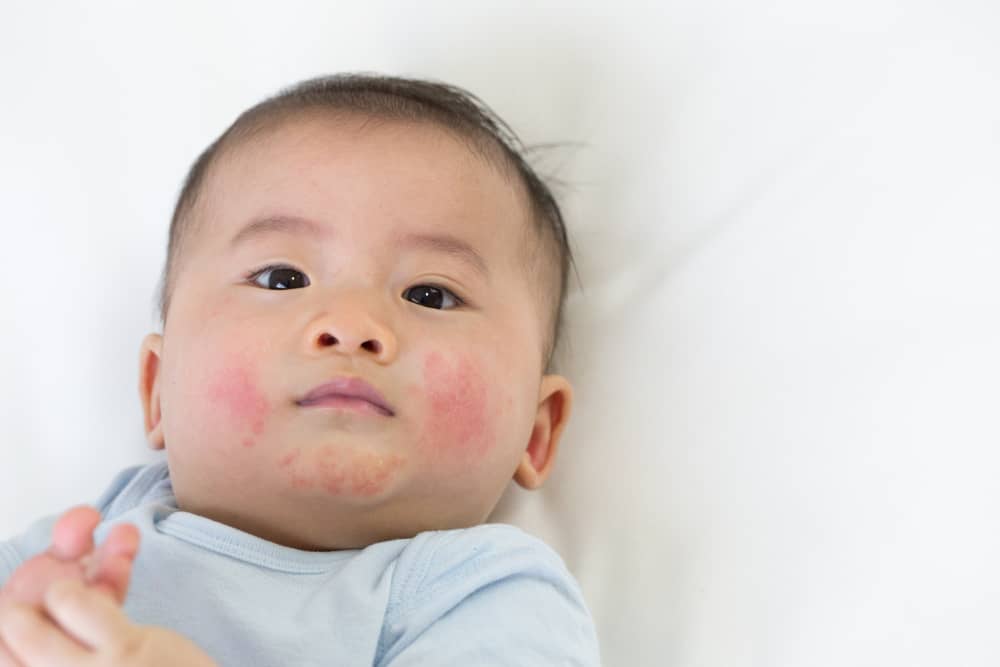 아기 피부염의 원인과 가장 흔한 증상