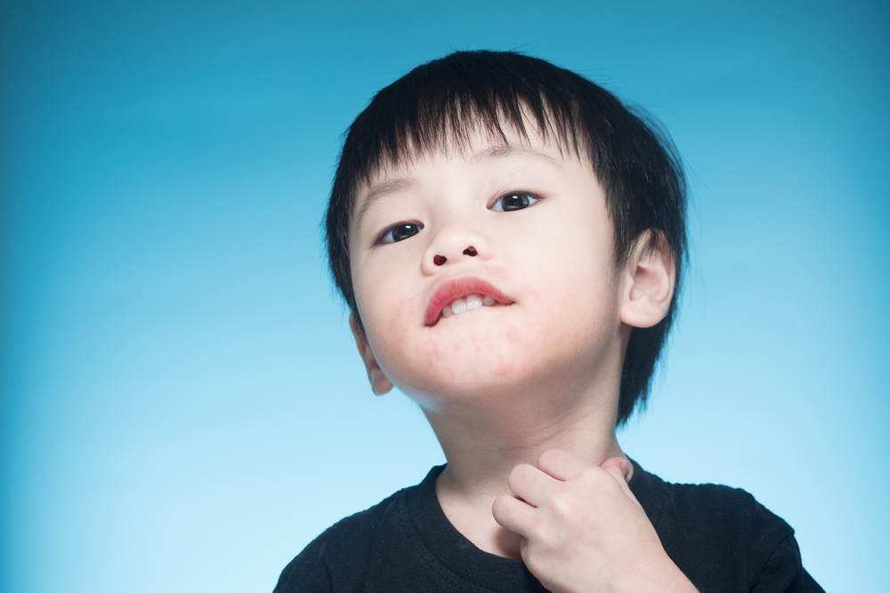 아이의 입 주위에 붉은 발진이 나타나는데 어떻게 대처해야 할까요?