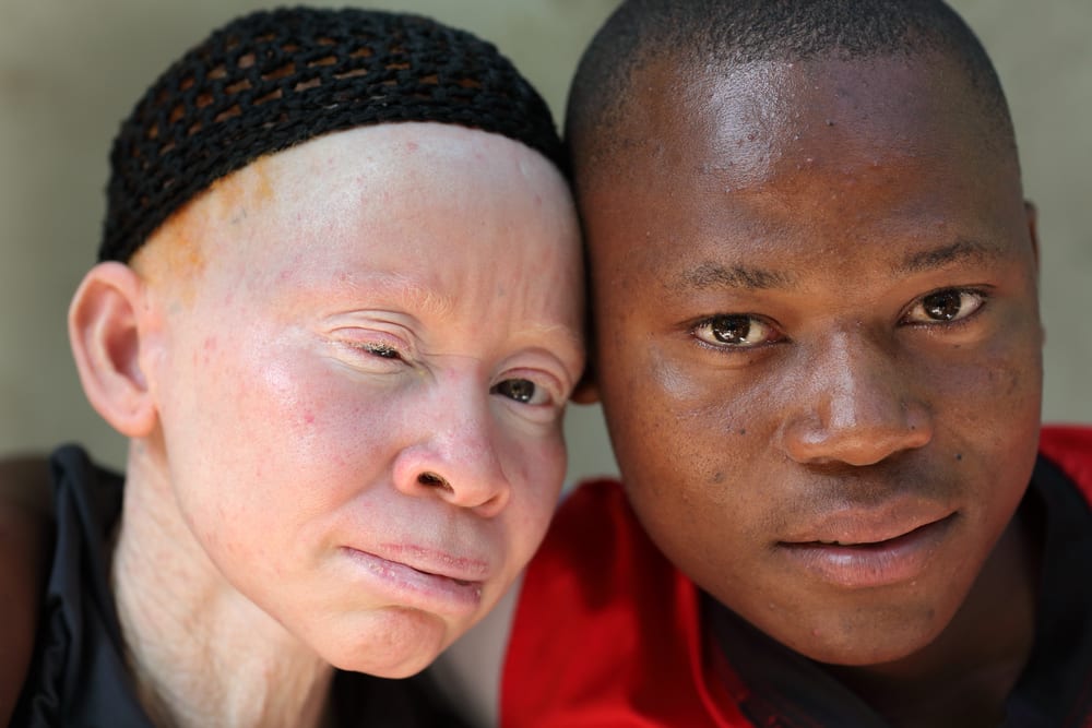 8 datos interesantes sobre el albinismo (albino) que necesita saber