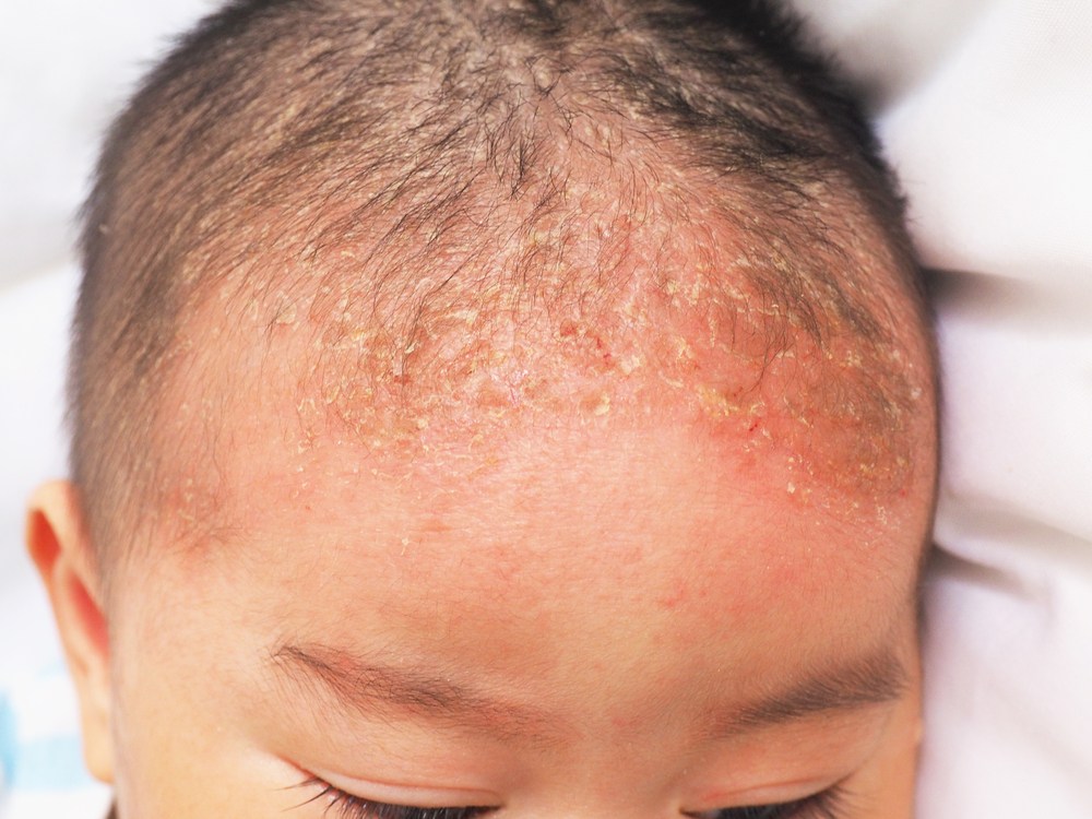 아기의 지루성 피부염(요람 모자)의 원인과 극복 방법