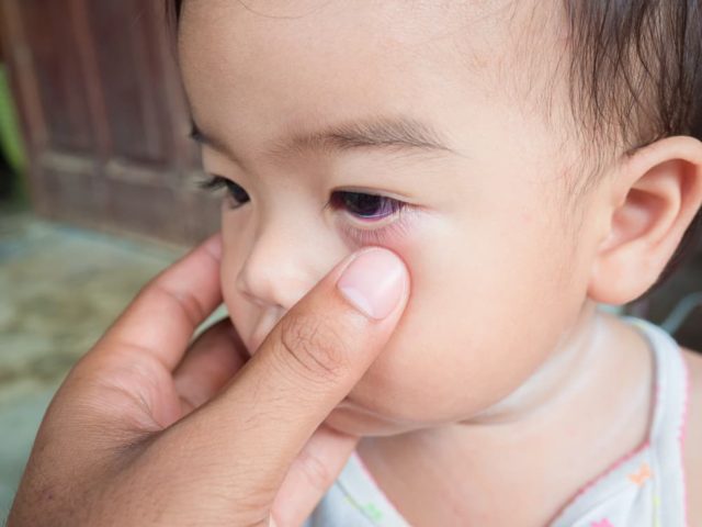 잠이 부족해서가 아니라 아기의 판다 눈이 생기는 4가지 원인