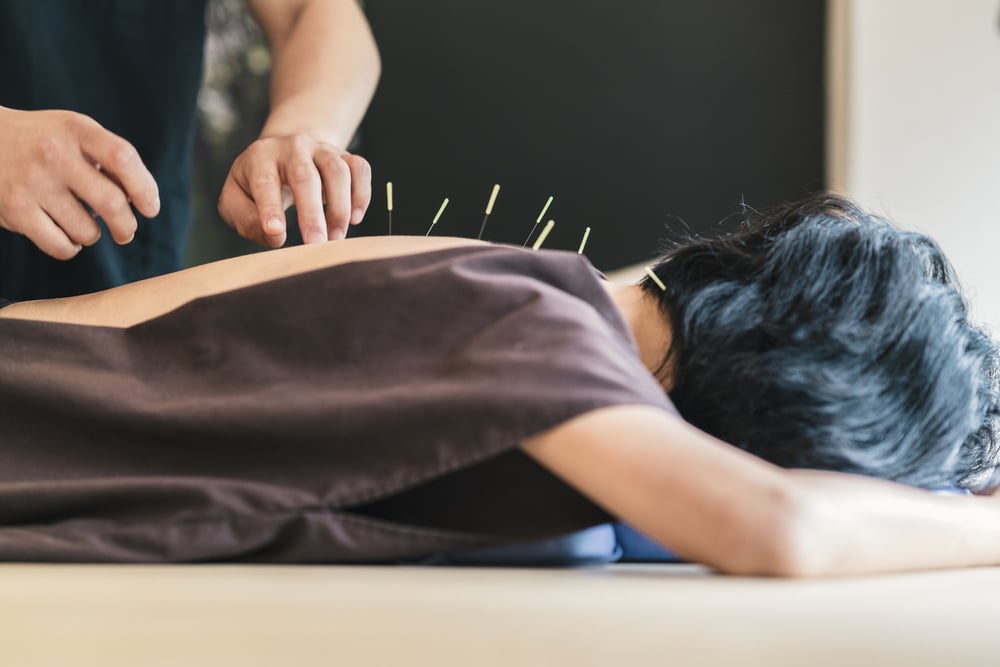 7 mögliche Nebenwirkungen von Akupunktur