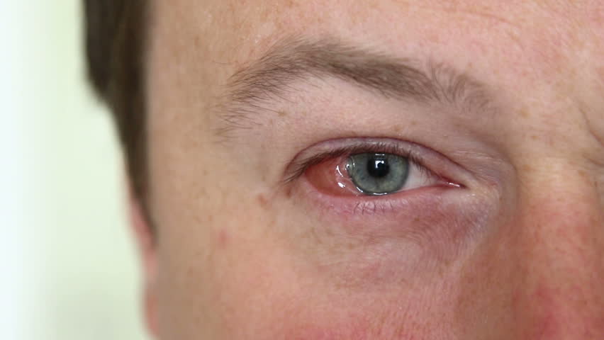 헤르페스 바이러스가 눈을 공격할 수 있습니다. 징후와 증상은 무엇입니까?
